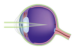 Nearsightedness (myopia)